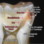  🦷 Quando a Cárie Avança — Entenda Cada Fase e o Que Fazer!